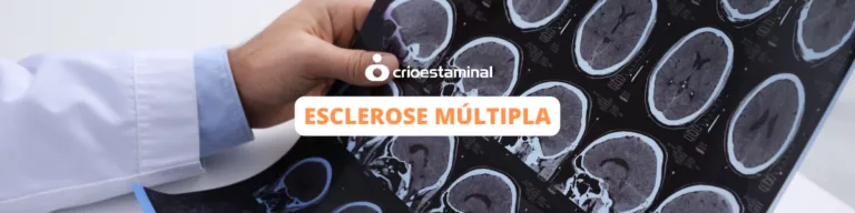 Doentes com esclerose múltipla melhoram após tratamentos com células estaminais do tecido do cordão umbilical