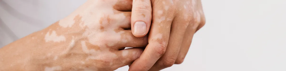 Vesículas de células estaminais do tecido do cordão umbilical no tratamento de vitiligo